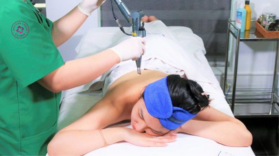 laser hỗ trợ thâm mụn lưng