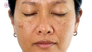 laser pico làm một lần có hết nám không hay phải làm nhiều lần