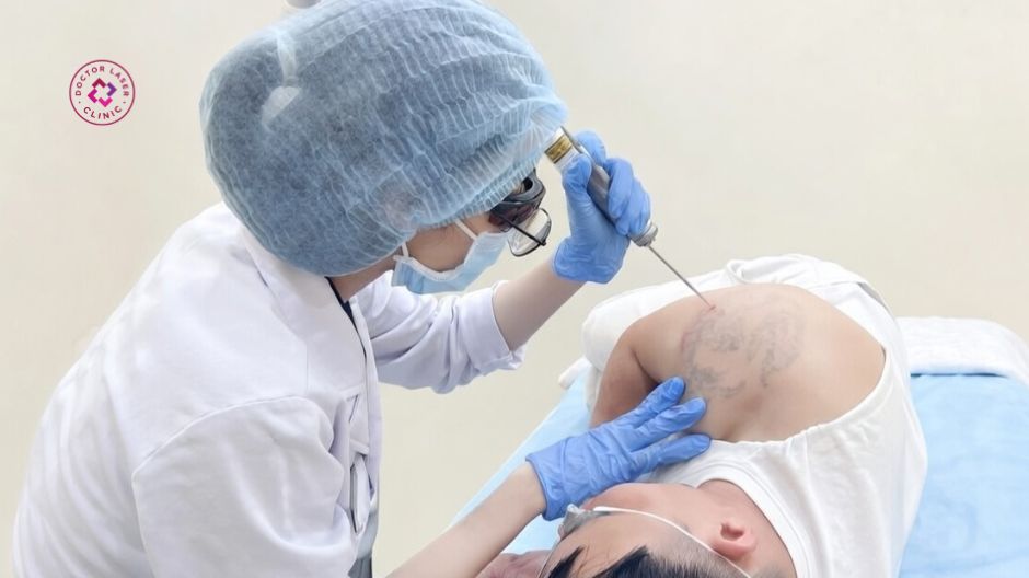 laser pico xoá xăm công nghệ picosecond