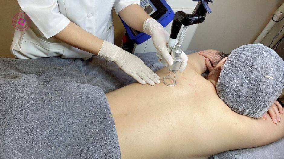 laser trị mụn lưng hiệu quả