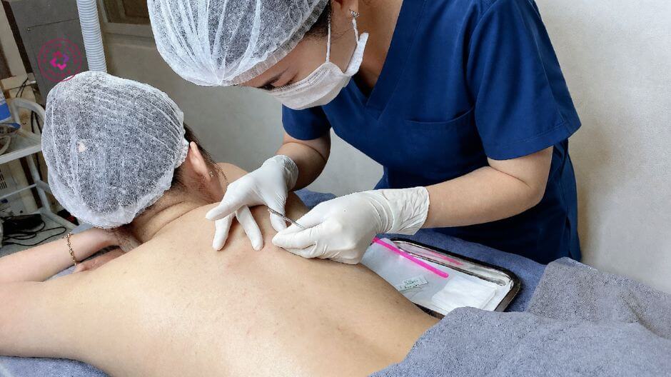 lấy nhân mụn lưng chuẩn y khoa