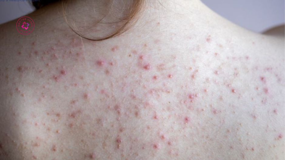 mất cân bằng hệ vi sinh mụn lưng giai đoạn 3