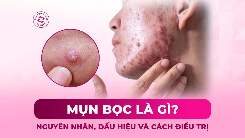 Mụn bọc là gì? Nguyên nhân, dấu hiệu và cách điều trị
