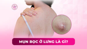 mụn bọc ở lưng là gì mụn bọc ở lưng là gì