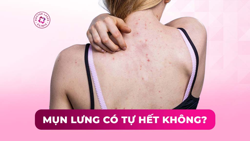 Mụn lưng có tự hết không? Rủi ro nếu không can thiệp