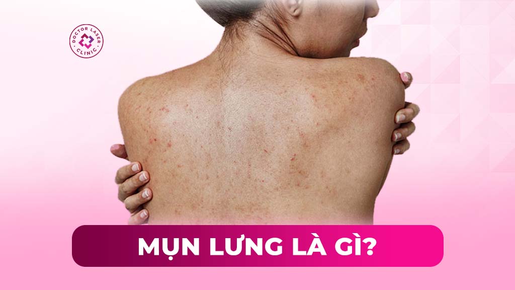 Mụn lưng: Phân loại, nguyên nhân, điều trị và phòng ngừa