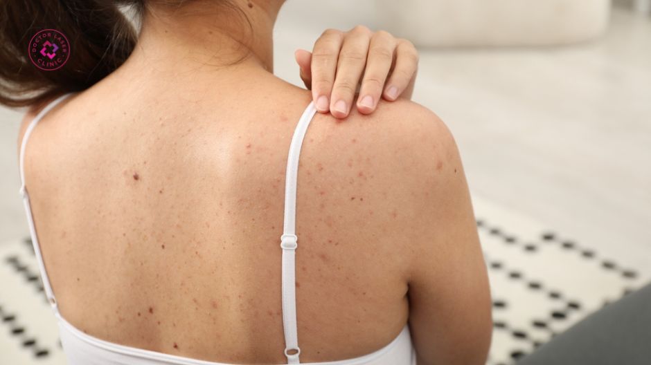 mụn lưng ở thanh thiếu niên