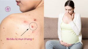 Mụn lưng thai kỳ có nguy hiểm không