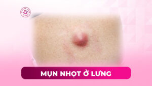 mụn nhọt ở lưng mụn nhọt ở lưng