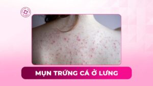 mụn trứng cá ở lưng mụn trứng cá ở lưng