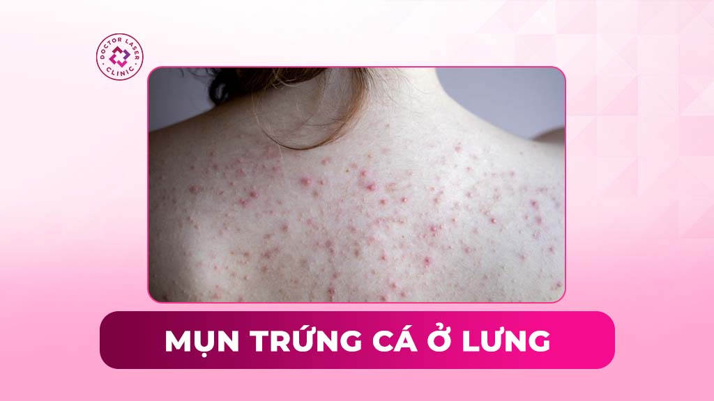 Mụn trứng cá ở lưng: Nguyên nhân và cách điều trị hiệu quả
