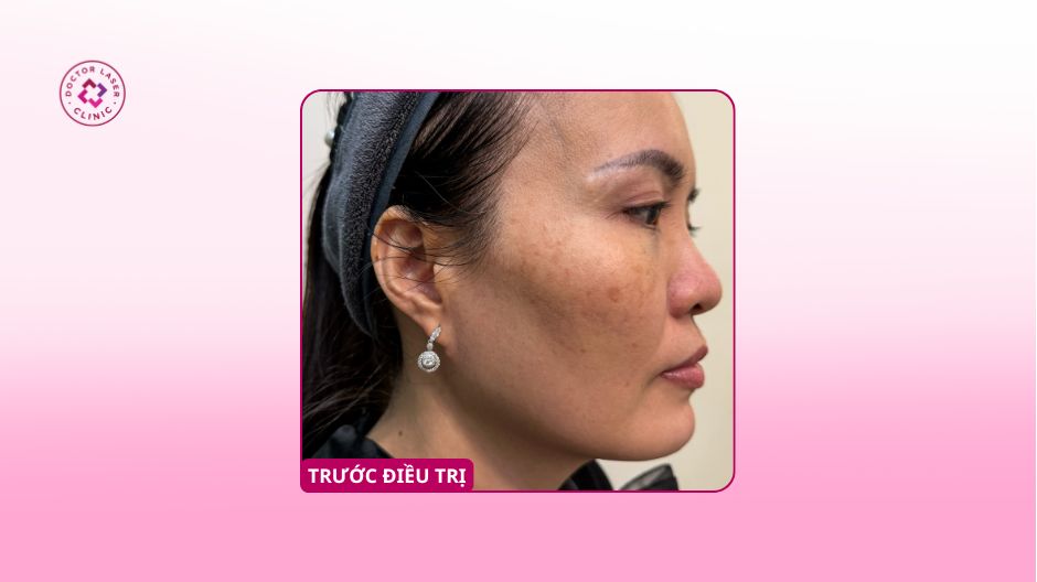 nám hai bên má trước điều trị laser pico
