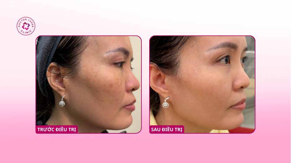 nám hai bên má trước sau điều trị laser pico