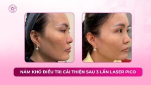 nám khó điều trị cải thiện sau 3 lần laser pico