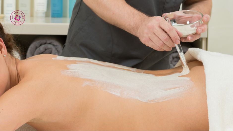 peel da hoá học trị mụn lưng aha bha tca