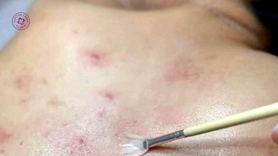 peel da hoá học trị mụn lưng