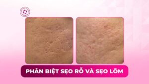 phân biệt sẹo rỗ và sẹo lõm