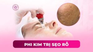 phi kim trị sẹo rỗ