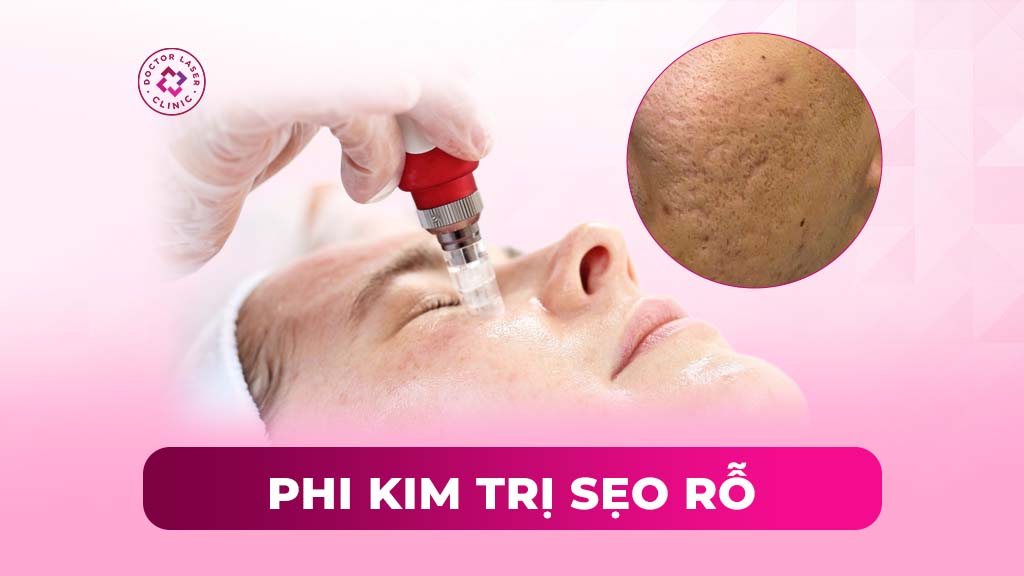 Phi kim trị sẹo rỗ là gì? Có hiệu quả không?