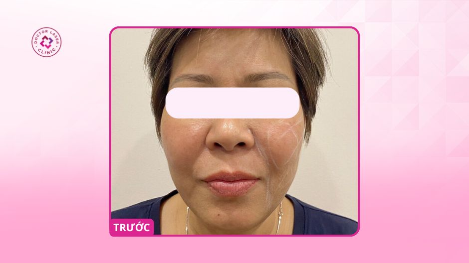 rãnh cười rõ và da kém săn chắc trước khi căng chỉ