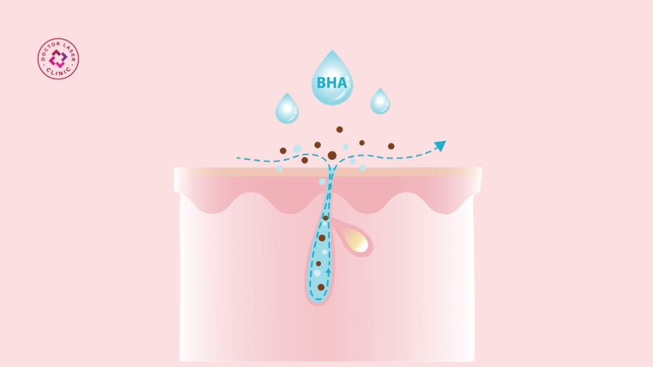 salicylic acid bha trị mụn lưng