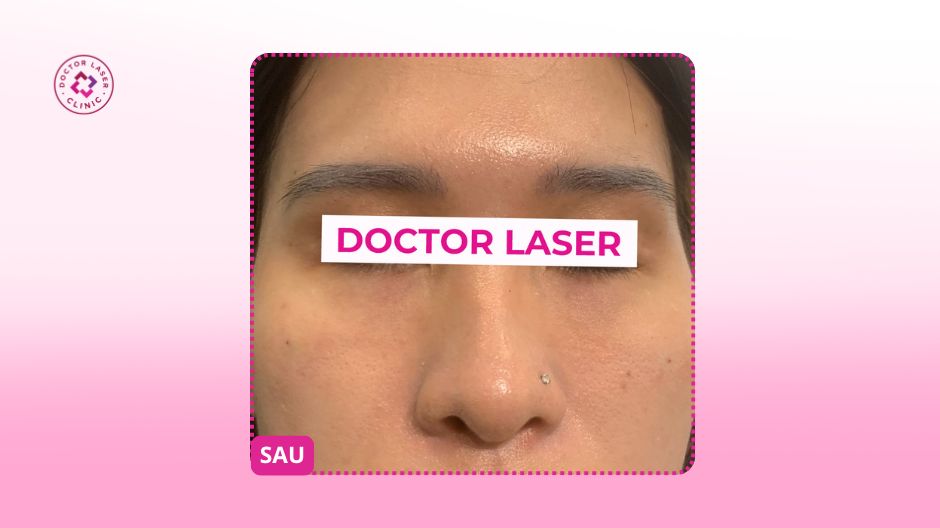 sau điều trị filler trũng mắt thâm quầng