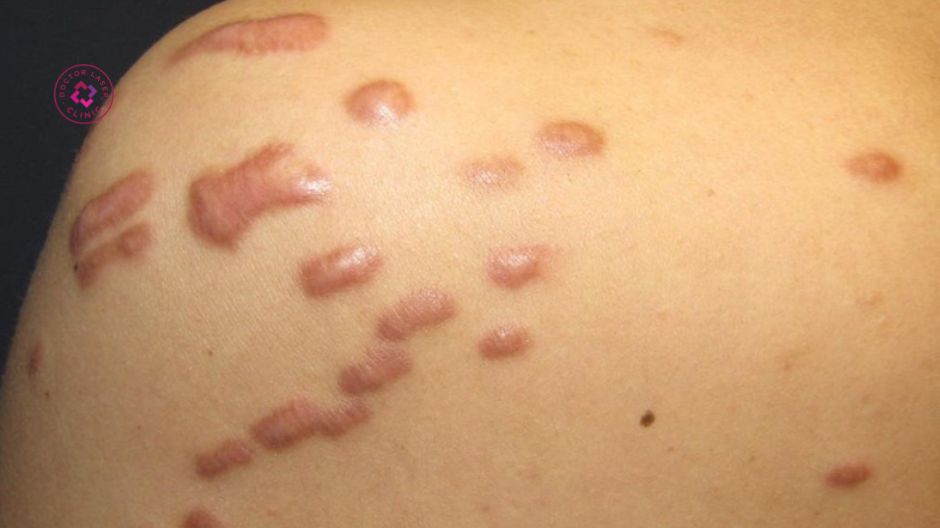 sẹo lồi vùng lưng sau viêm da kéo dài