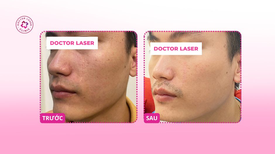 sẹo lõm sau tai nạn trước và sau 2 lần laser co2