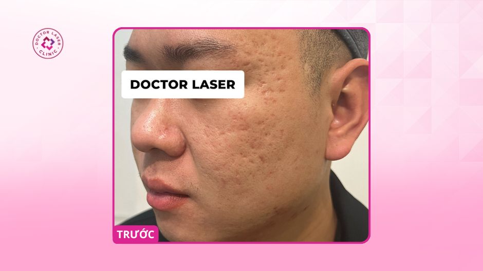 sẹo rỗ 10 năm trước điều trị laser co2