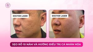 sẹo rỗ 10 năm và hướng điều trị cá nhân hoá