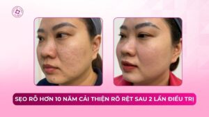 sẹo rỗ hơn 10 năm cải thiện rõ rệt sau 2 lần điều trị