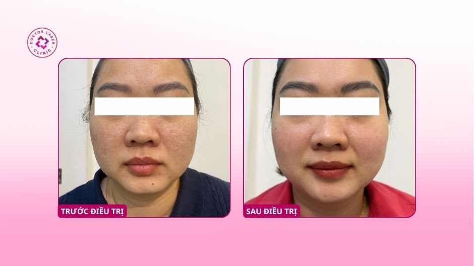 sẹo rỗ lâu năm sau 2 lần điều trị