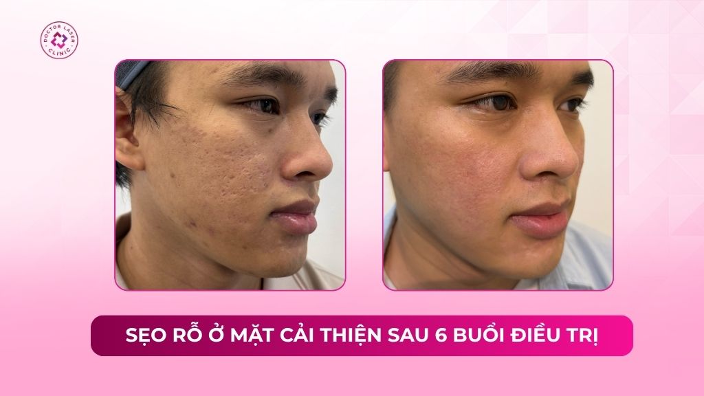 sẹo rỗ ở mặt cải thiện sau 6 buổi điều trị