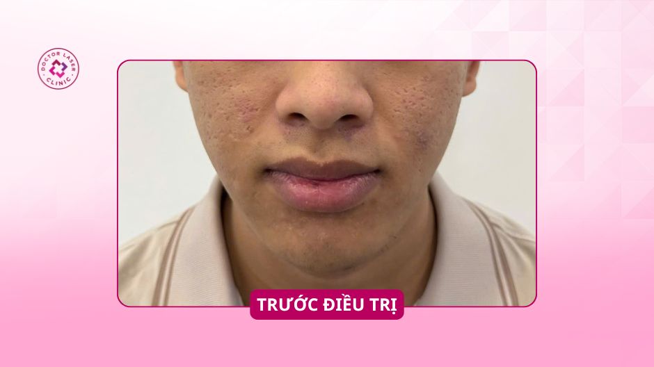 sẹo rỗ ở mặt trước điều trị