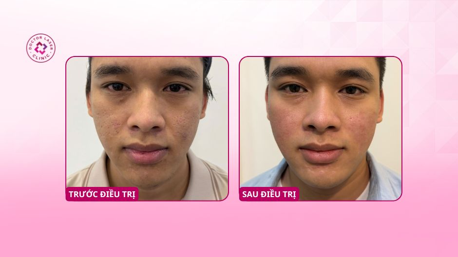 sẹo rỗ ở mặt trước và sau điều trị