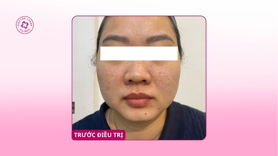 sẹo rỗ trước điều trị 10 năm