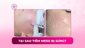 tại sao tiêm meso bị sưng