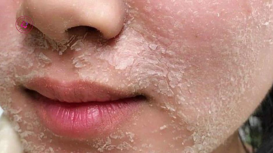 tần suất peel da ảnh hưởng đến tốc độ phục hồi và hiệu quả