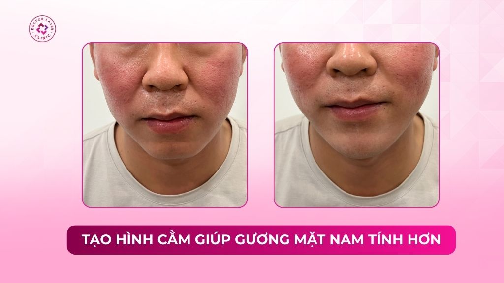tạo hình cằm giúp gương mặt nam tính hơn