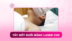 tẩy nốt ruồi bằng laser co2
