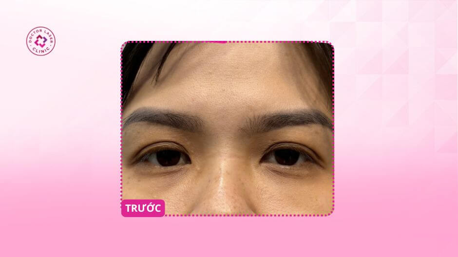 thâm mắt lâu năm trước điều trị laser pico meso