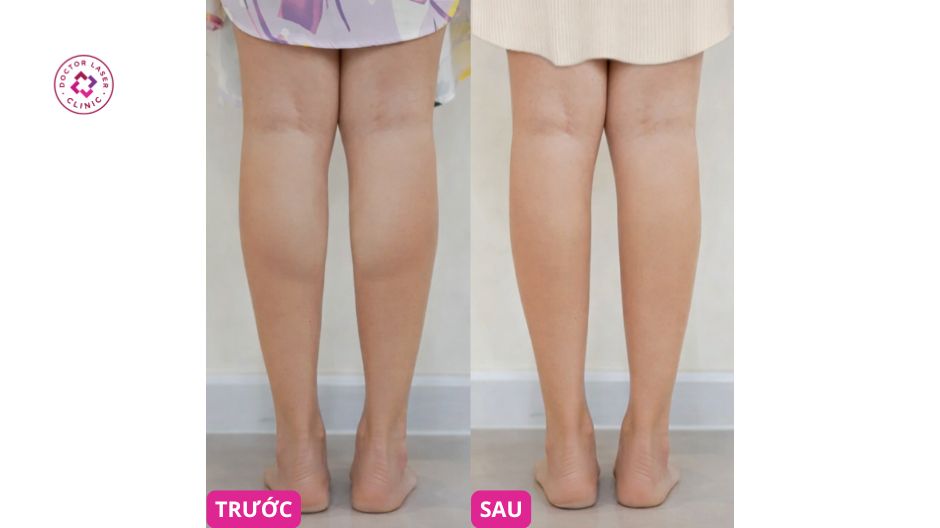 tiêm botox bắp chân trước sau