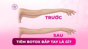 tiêm botox bắp tay là gì