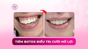 tiêm botox điều trị cười hở lợi