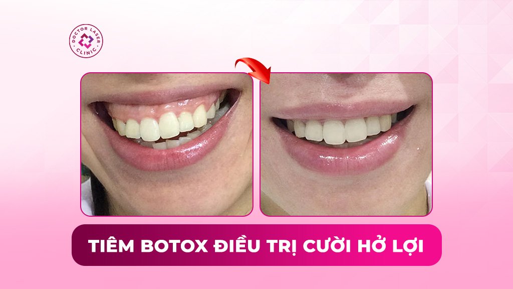 Tiêm botox điều trị cười hở lợi có hiệu quả không?