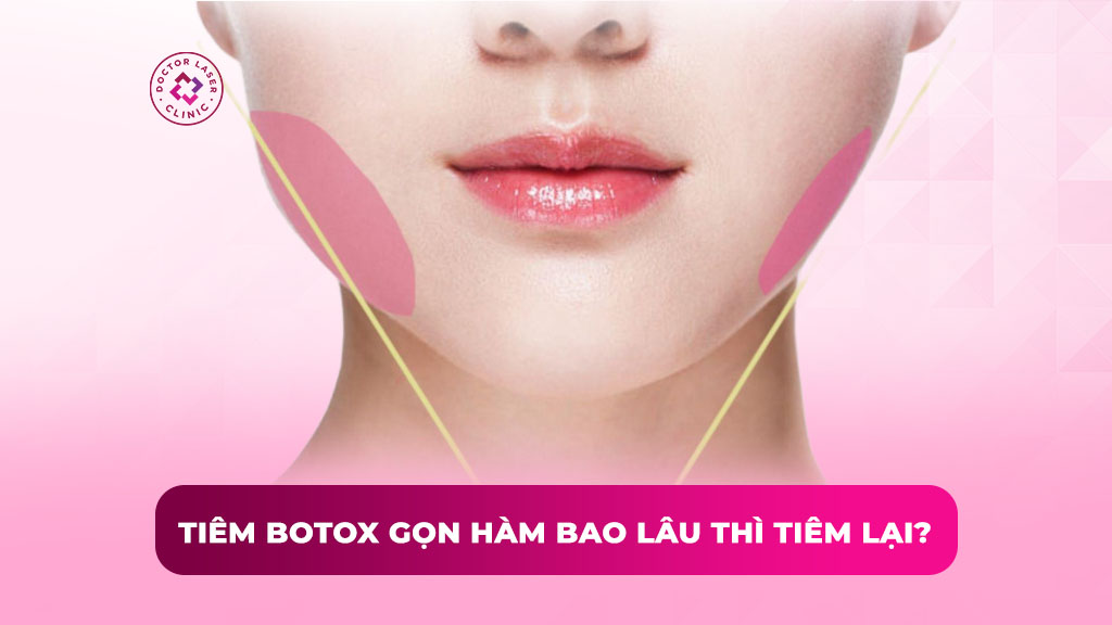 tiêm botox gọn hàm bao lâu thì tiêm lại