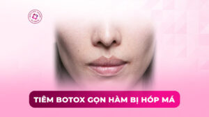 tiêm botox gọn hàm bị hóp má