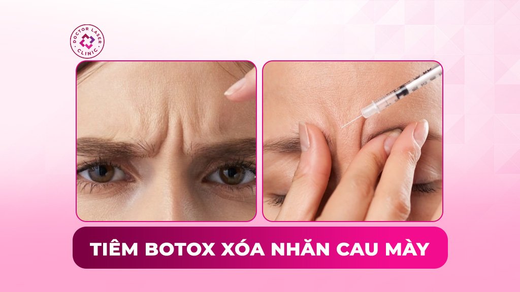 Có nên tiêm botox xóa nhăn cau mày không?
