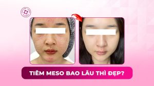 tiêm meso bao lâu thì đẹp