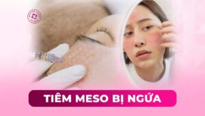 tiêm meso bị ngứa